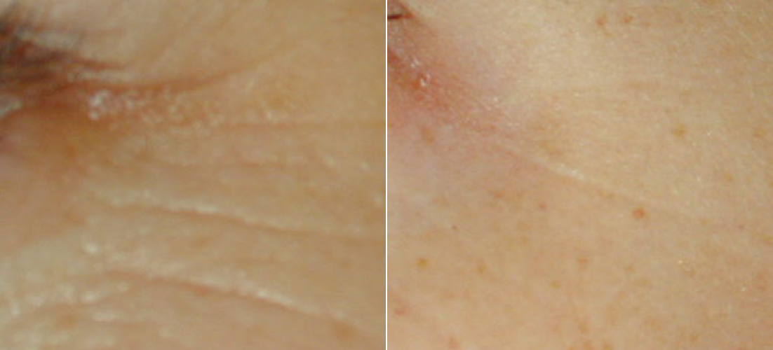 Laser Genesis B&A 2.png