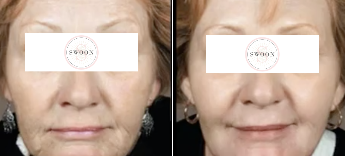 Halo B&A 2.png