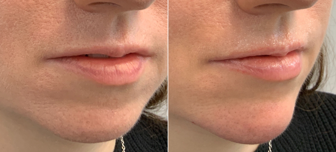 Chin FIller B&A 2.png