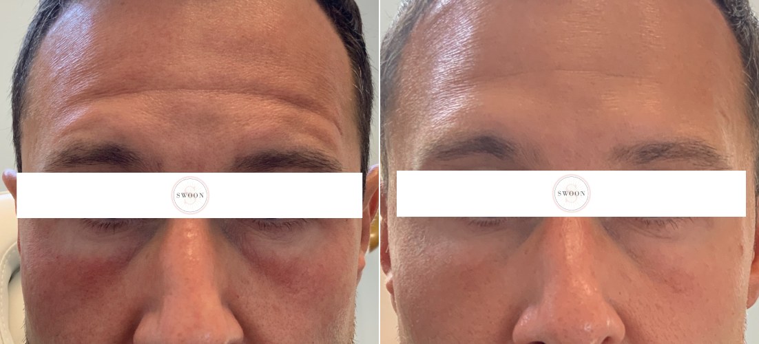 PRP Undereye B&A 1-2.png