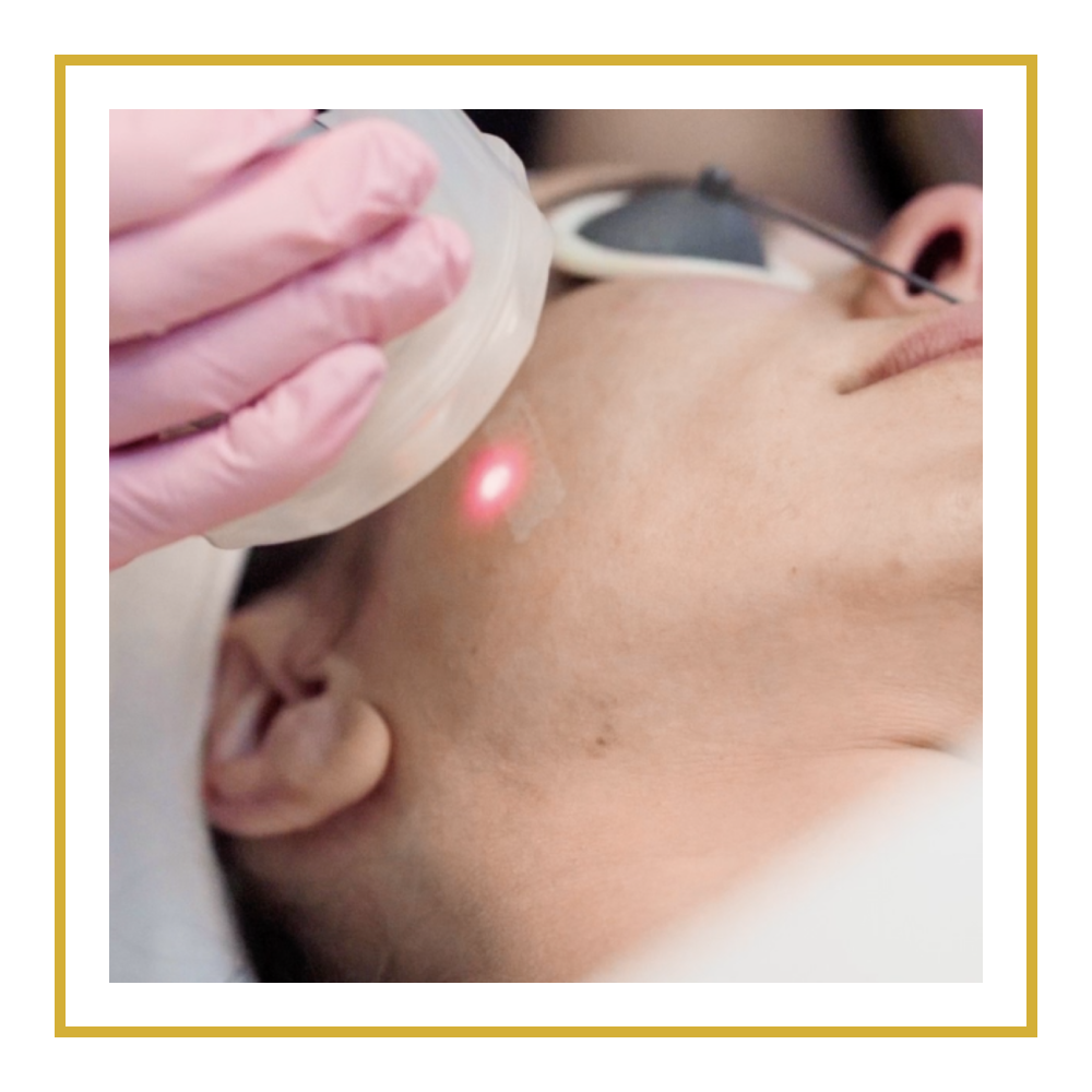 CONCERNS_MICRO_LASER_PEEL.png