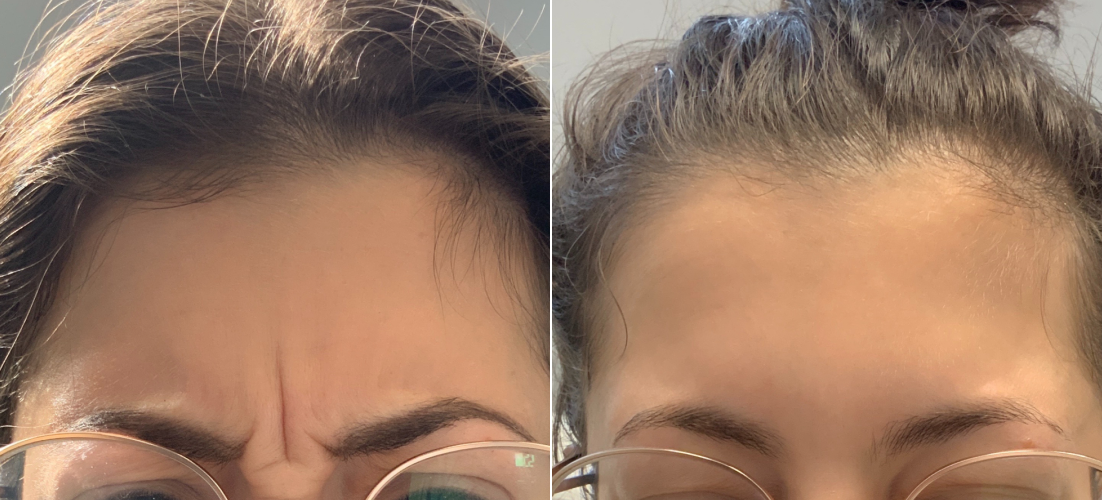 Botox B&A 2.png