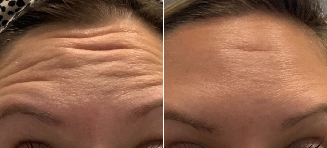 Dysport B&A 4.png