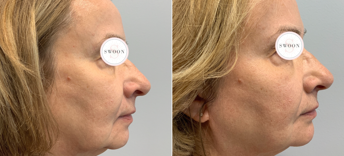 PRP Facelift B&A 3.png