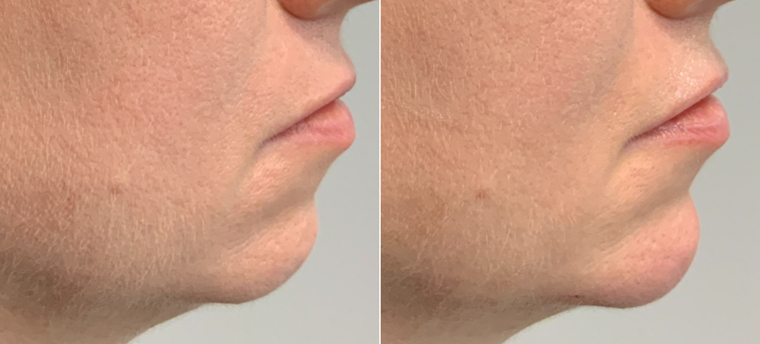 Chin FIller B&A 1.png