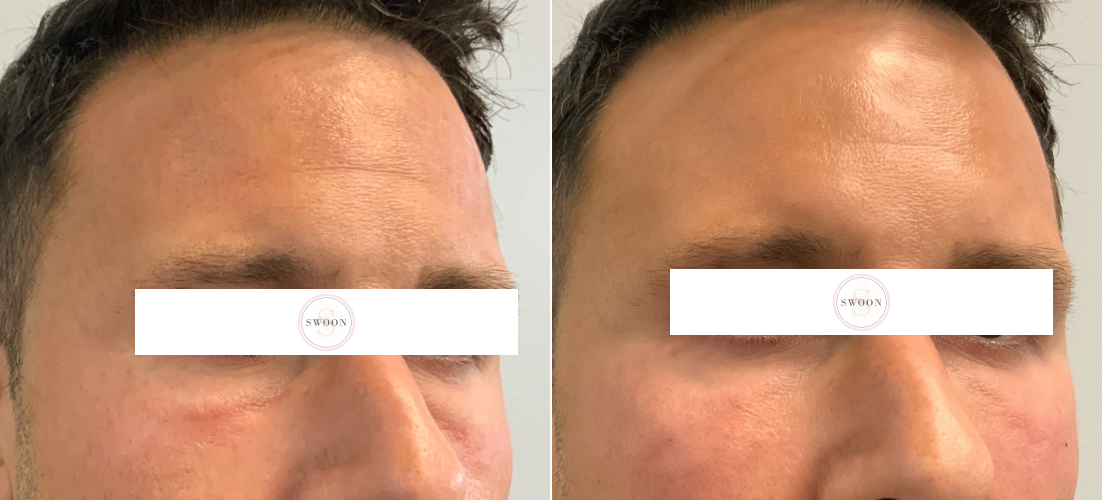 PRP Undereye B&A 2-3.png