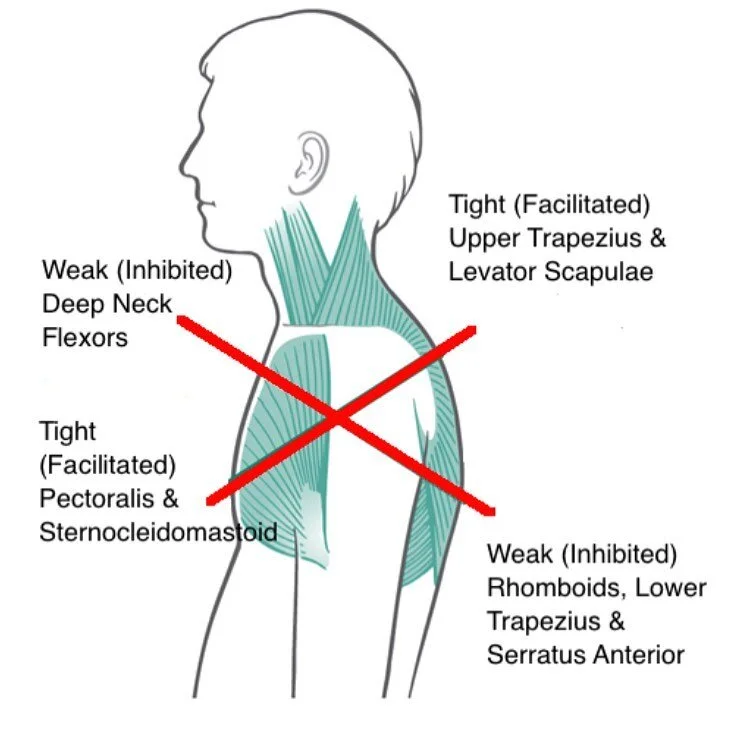 Upper Cross Syndrome is a generalized postural condition either caused by poor biomechanics or a structural issue brought on by a pathology. #massagetherapy with a qualified #massagetherapist can help reduce associated pain and discomfort and assist 