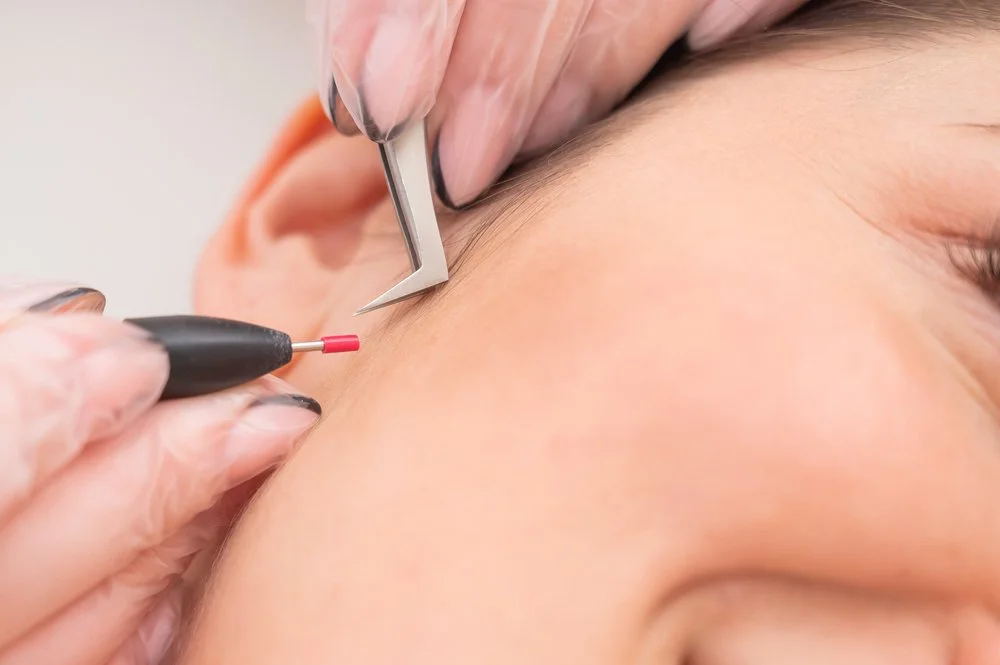 Electrolysis Queens,