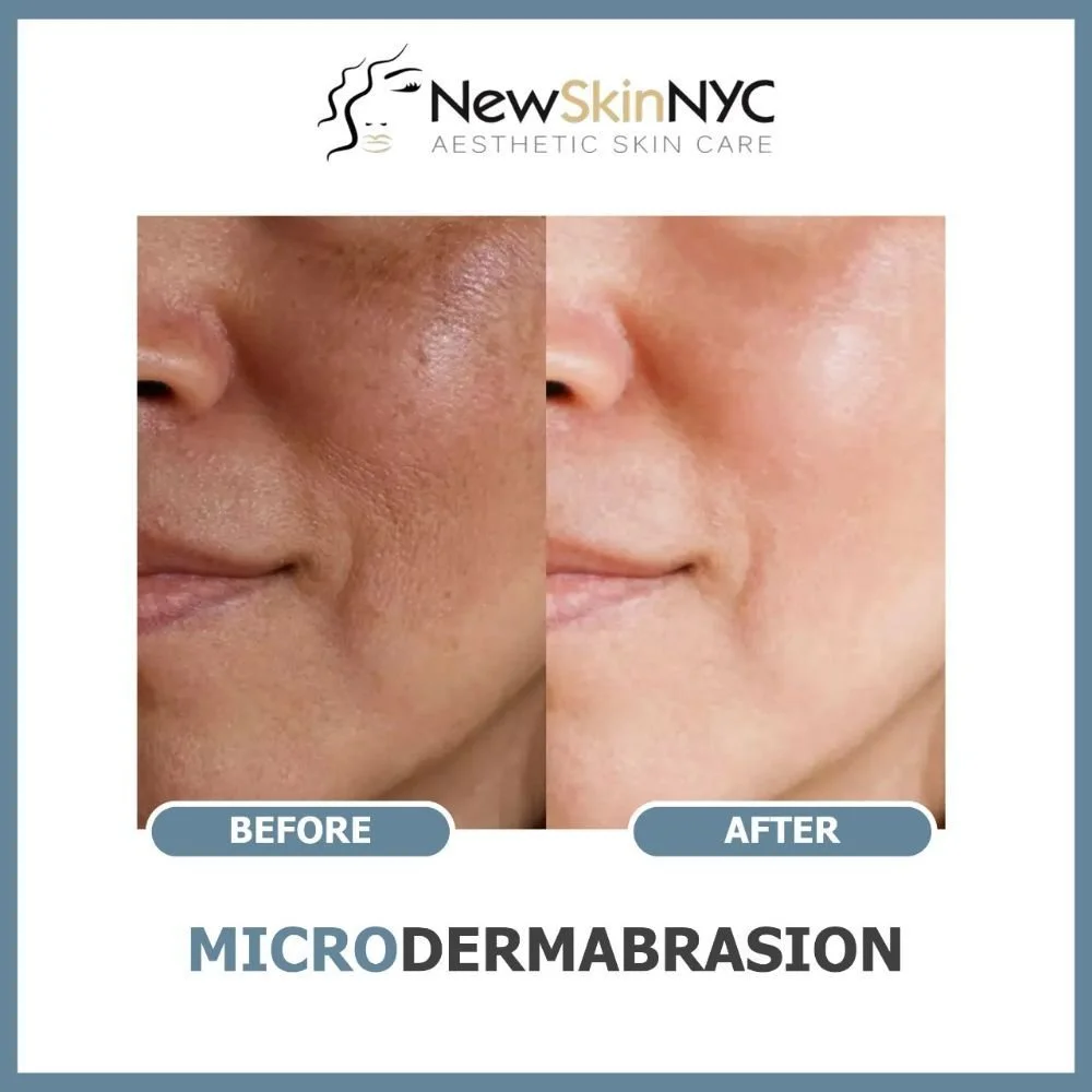 Deep-cleaning facial with diamond microdermabrasion before and after at New Skin! In Maspeth, Queens! Clear clogged pores and blackheads with deep extractions, fade hyperpigmentation, sun damage, and dark spots, and smooth uneven skin tone and fine l