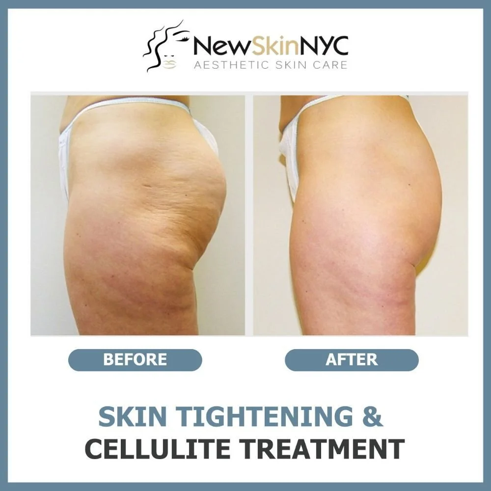 Cellulite Treatment in Queens, NY — New Skin NYC