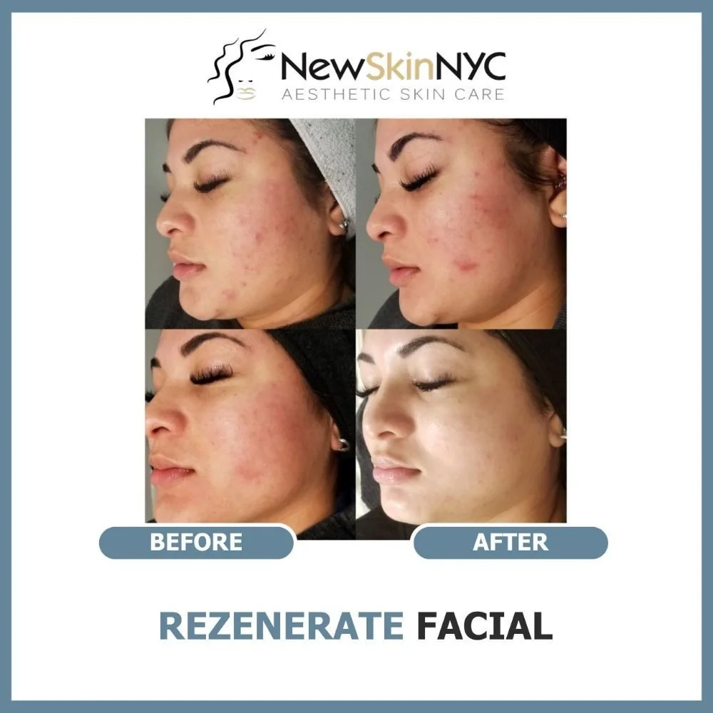 Side-by-side comparison of skin before and after microneedling for acne scarring: large pores, hyperpigmentation, dark spots, uneven skin tone. In Queens, NY at New Skin!  
