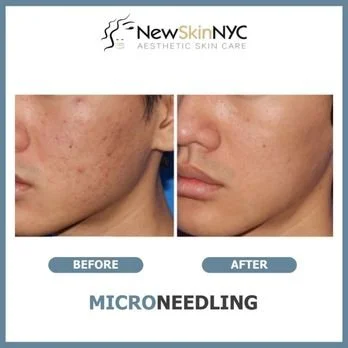 Side-by-side comparison of skin before and after microneedling for acne scarring: large pores, in  Queens, NY at New Skin!  
