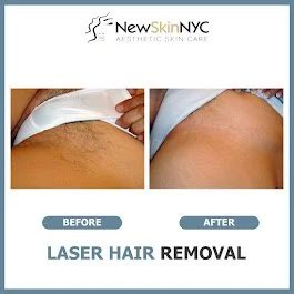 Brazilian and bikini line laser hair removal at New Skin NY in Maspeth, Queens! Safe for all skin tones using advanced laser technology to eliminate unwanted hair, reduce ingrown hairs, 