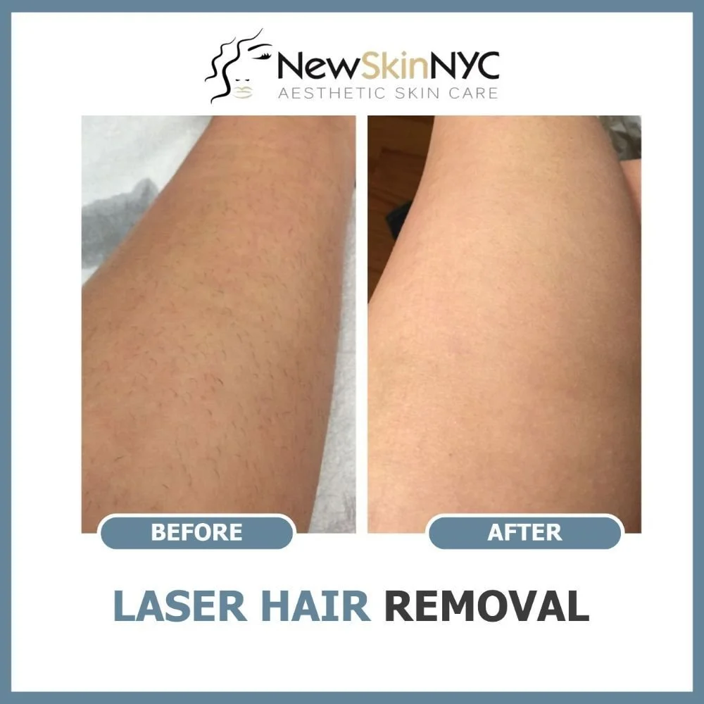 Laser hair removal on arms for strawberry skin on arms and legs in Queens, NY