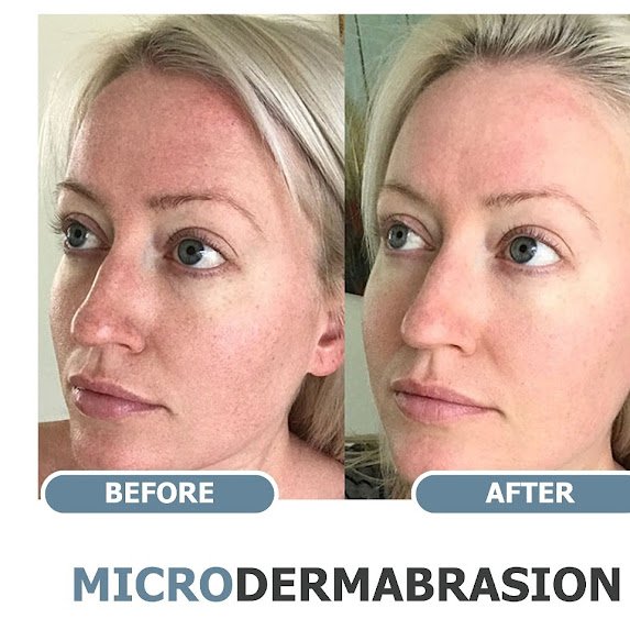 diamond microdermabrasion facial before and after at New Skin! in Maspeth, Queens! Clear clogged pores and blackheads with deep extractions, fade hyperpigmentation, sun damage, and dark spots, 