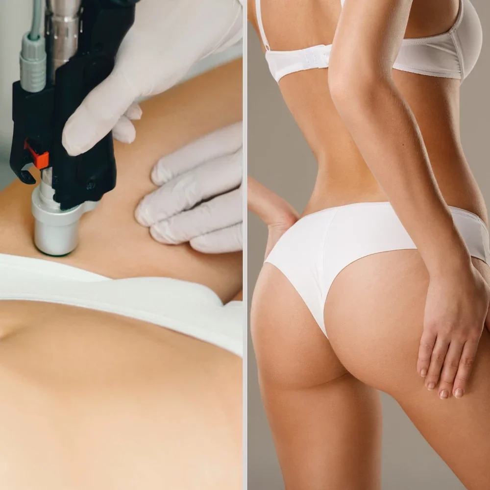 Brazilian Laser hair removal