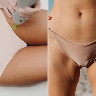Bikini Line Laser Hair Removal