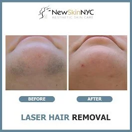 Chin laser hair removal before and after at New Skin NY, in Maspeth, Queens! Safe and effective for all skin tones, permanently reducing coarse chin hair, stopping razor bumps and ingrowns, 