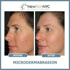 Deep-cleaning facial with diamond microdermabrasion before and after at New Skin in Maspeth, Queens! Gently resurface skin, clear clogged pores and blackheads with deep extractions, and fade uneven tone, blemishes, and fine lines.