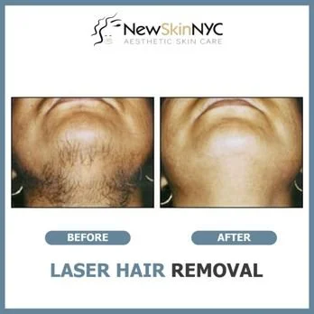 Laser Hair removal and electrolysis hair removal for PCOS hair removal  in Queens NY