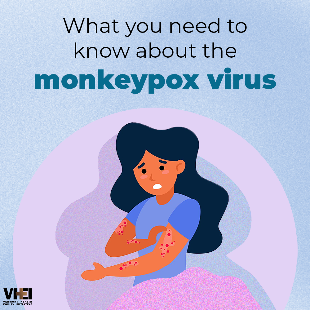 What You Need To Know About The Monkeypox Virus