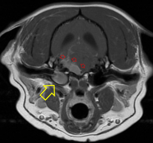   MRI: Otitis Media (yellow arrow) with extension into the brain (red arrows)