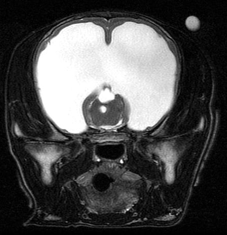 MRI-Hydrocephalus-5c47befebc388.png