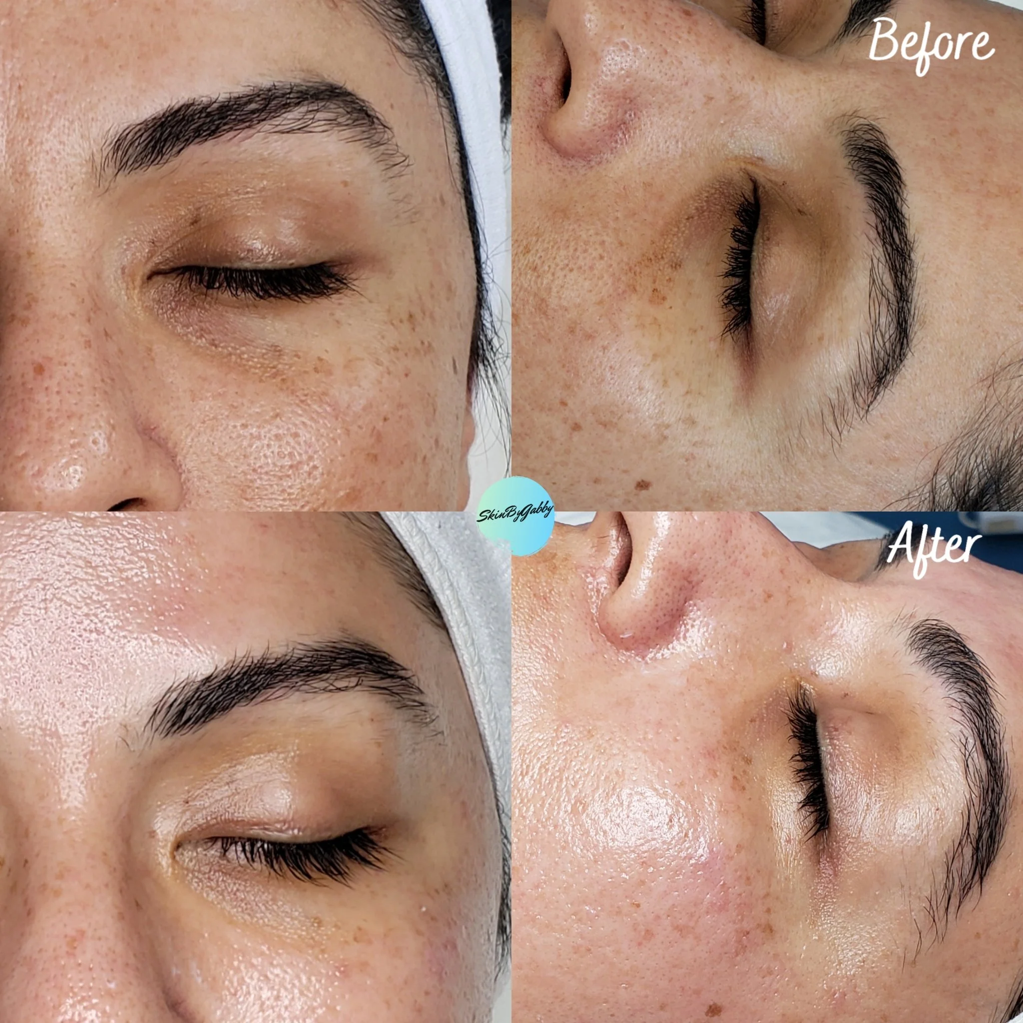 Skin Transformation