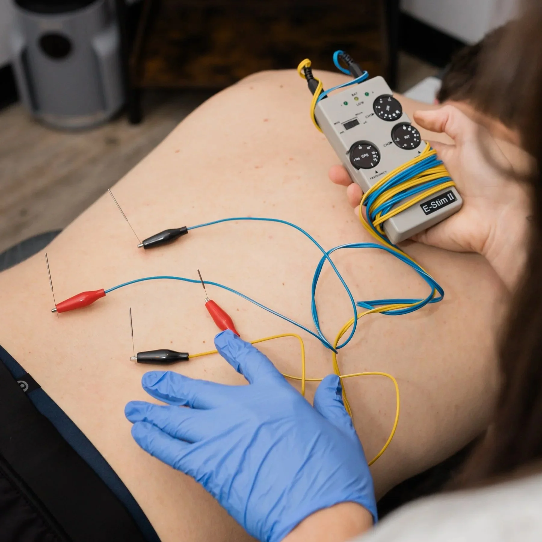 norman sports chiropractor performs dry needling for upper back and neck pain