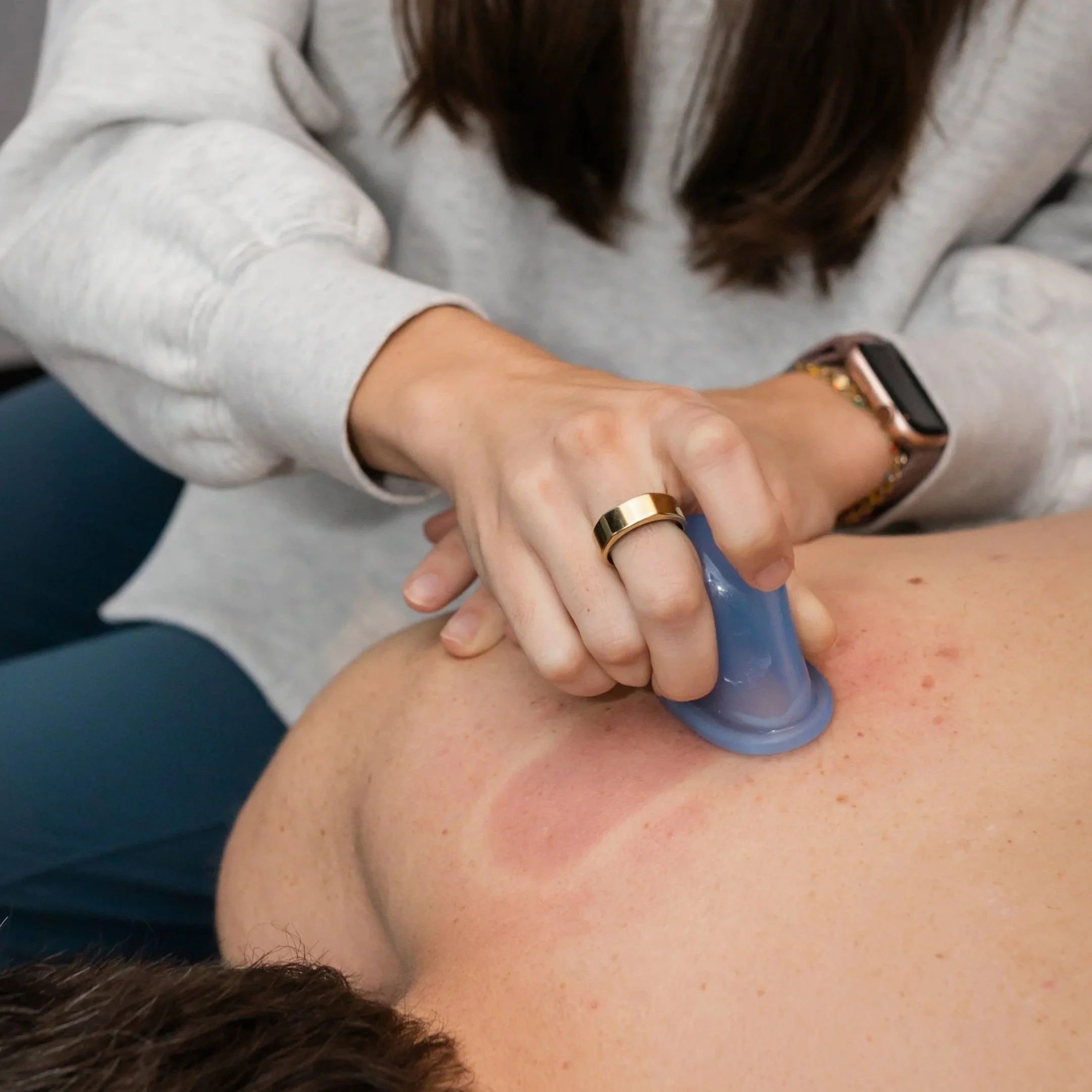 norman sports chiropractor performs cupping for low back pain