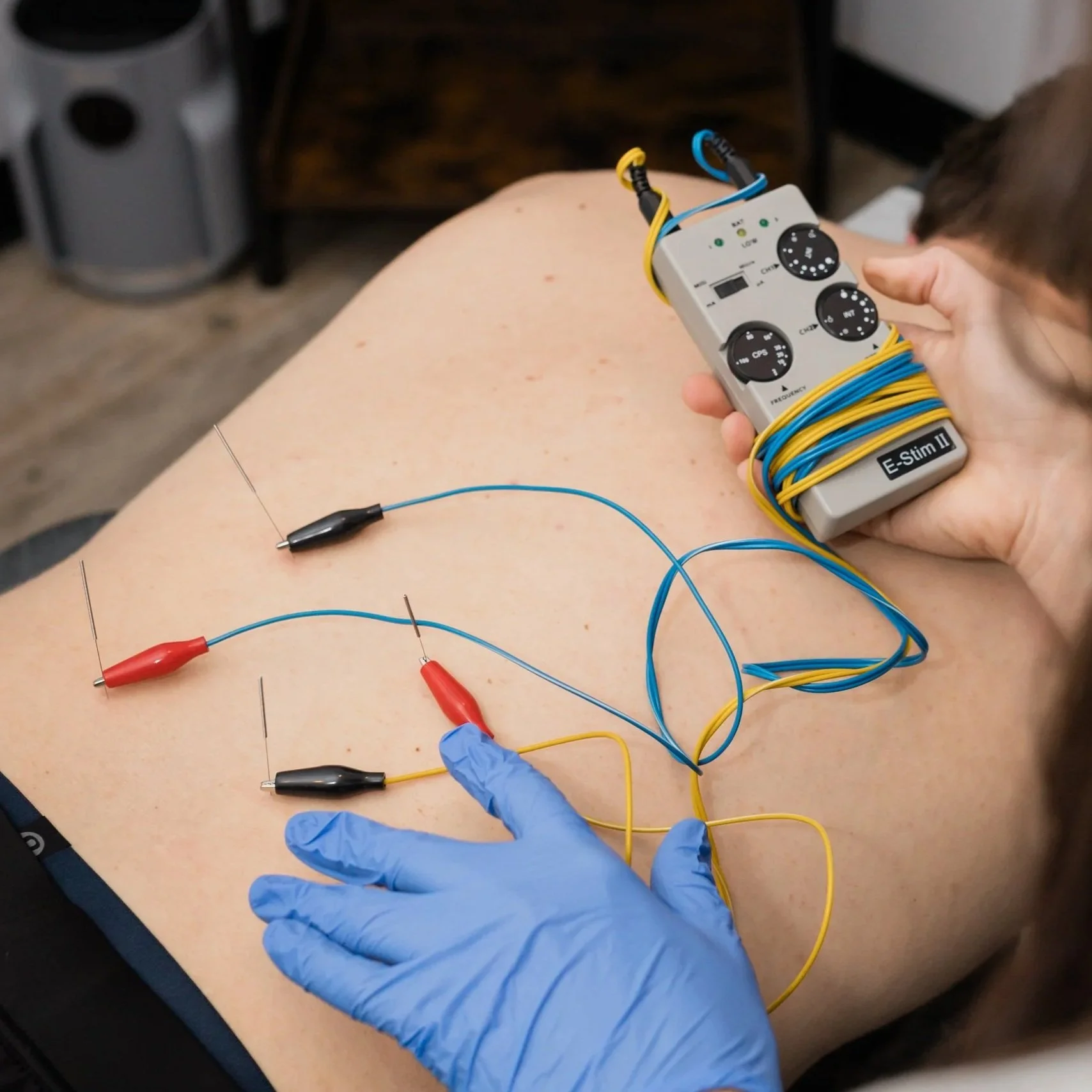 norman sports chiropractor performs dry needling for upper back and neck pain