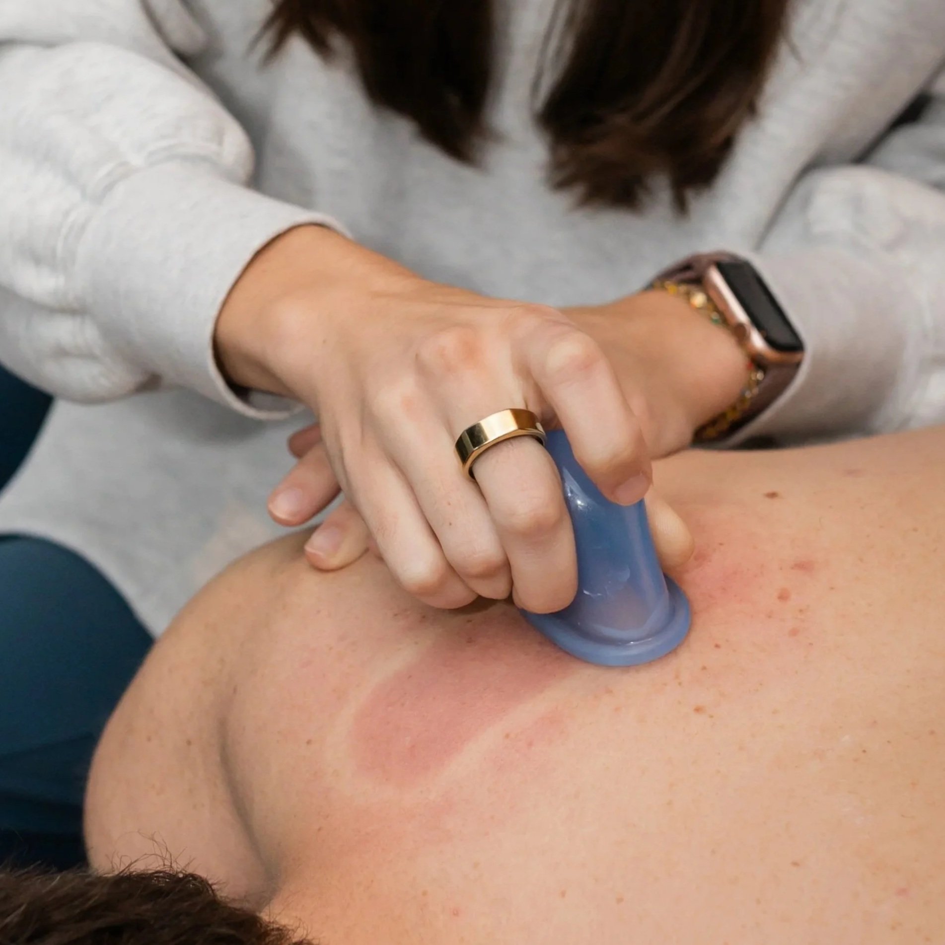 norman sports chiropractor performs cupping for low back pain