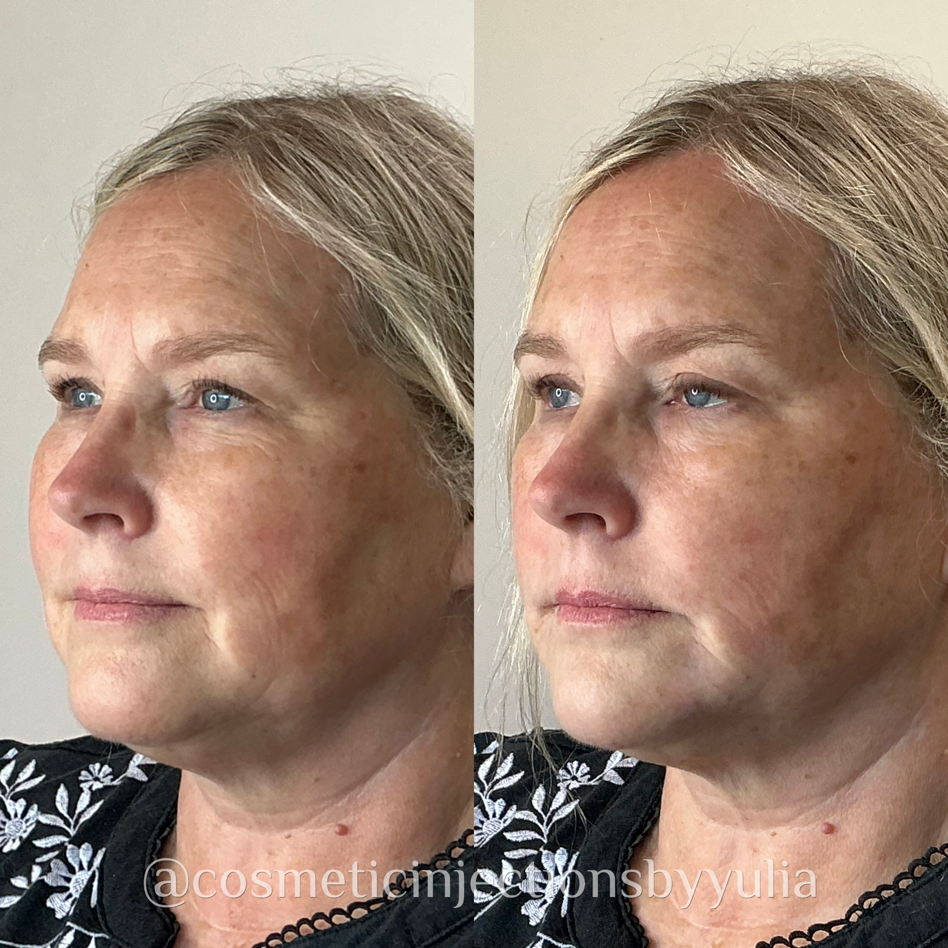 Filler to her chin and jawline for marionette line softening and balancing out facial proportions