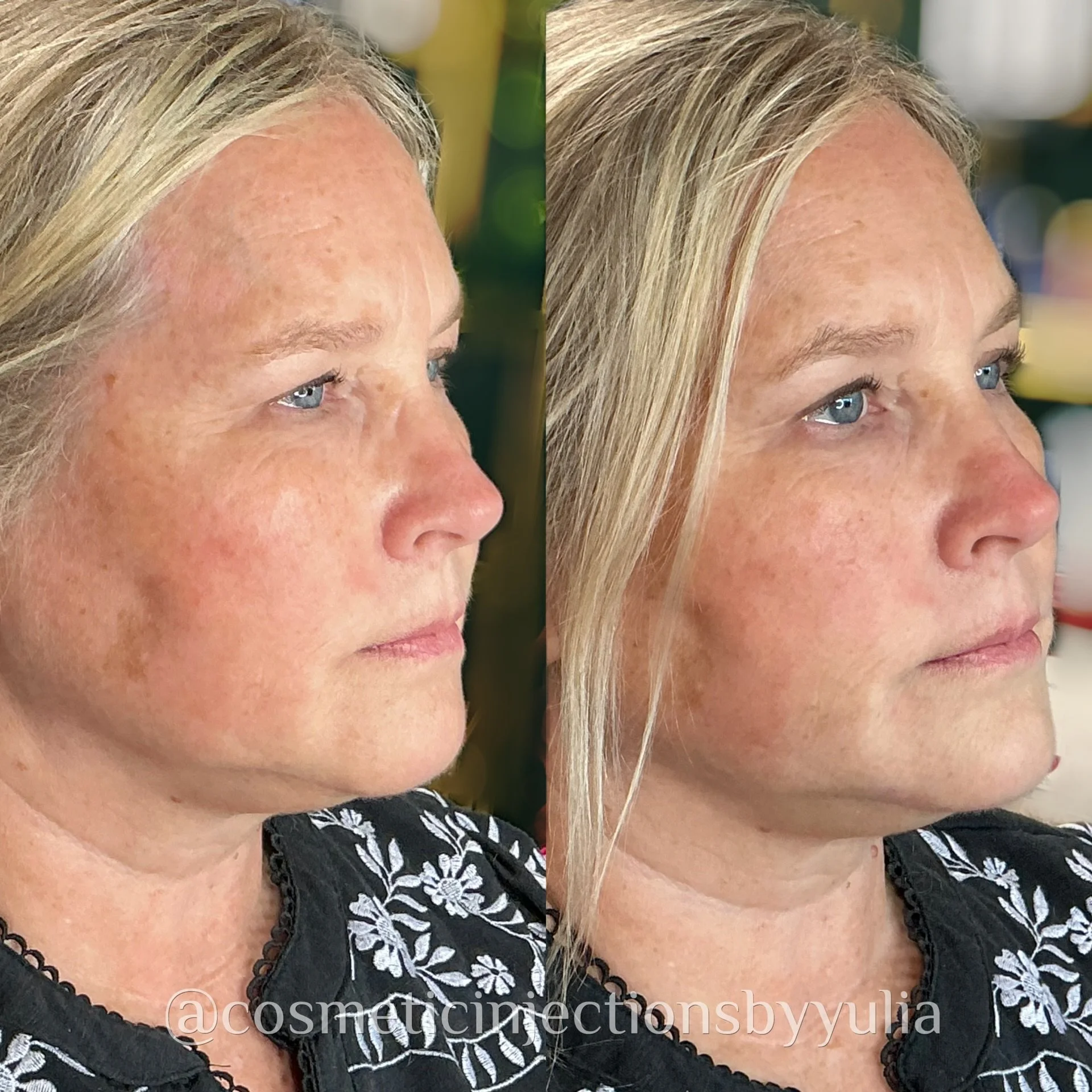Filler to her chin and jawline for marionette line softening and balancing out facial proportions