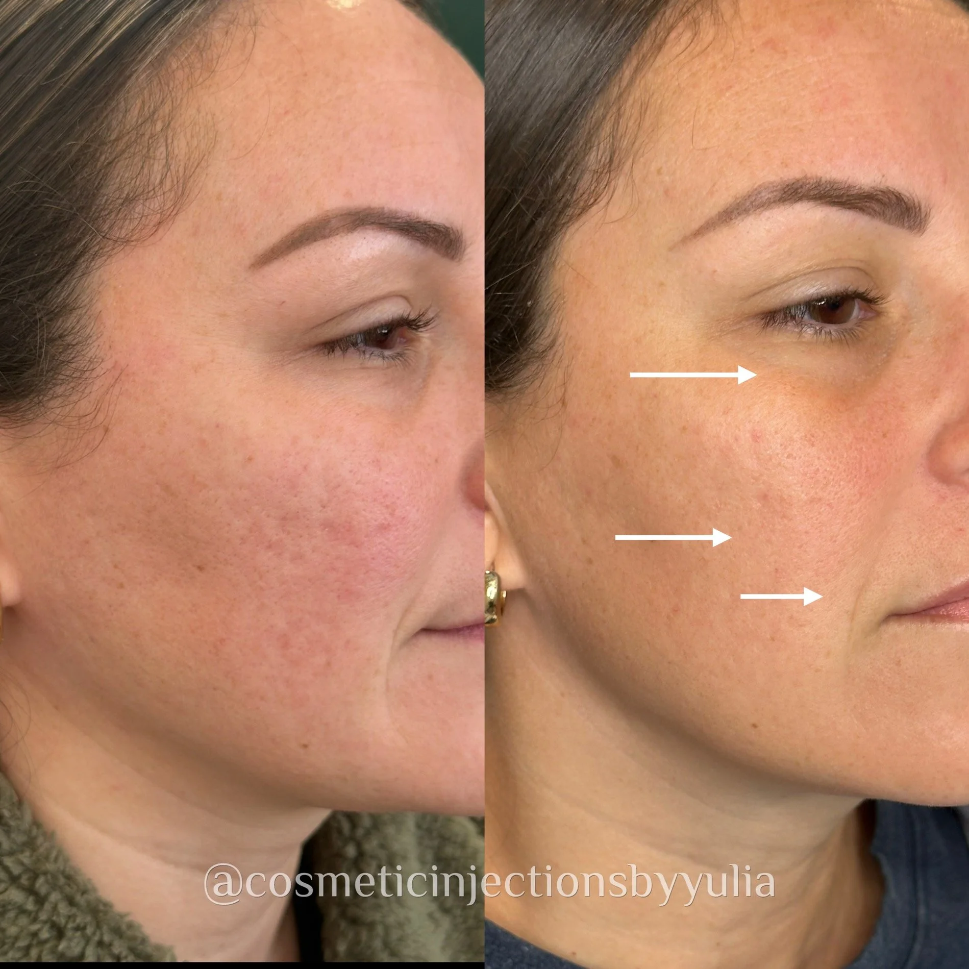 After only 2 SkinPen treatments