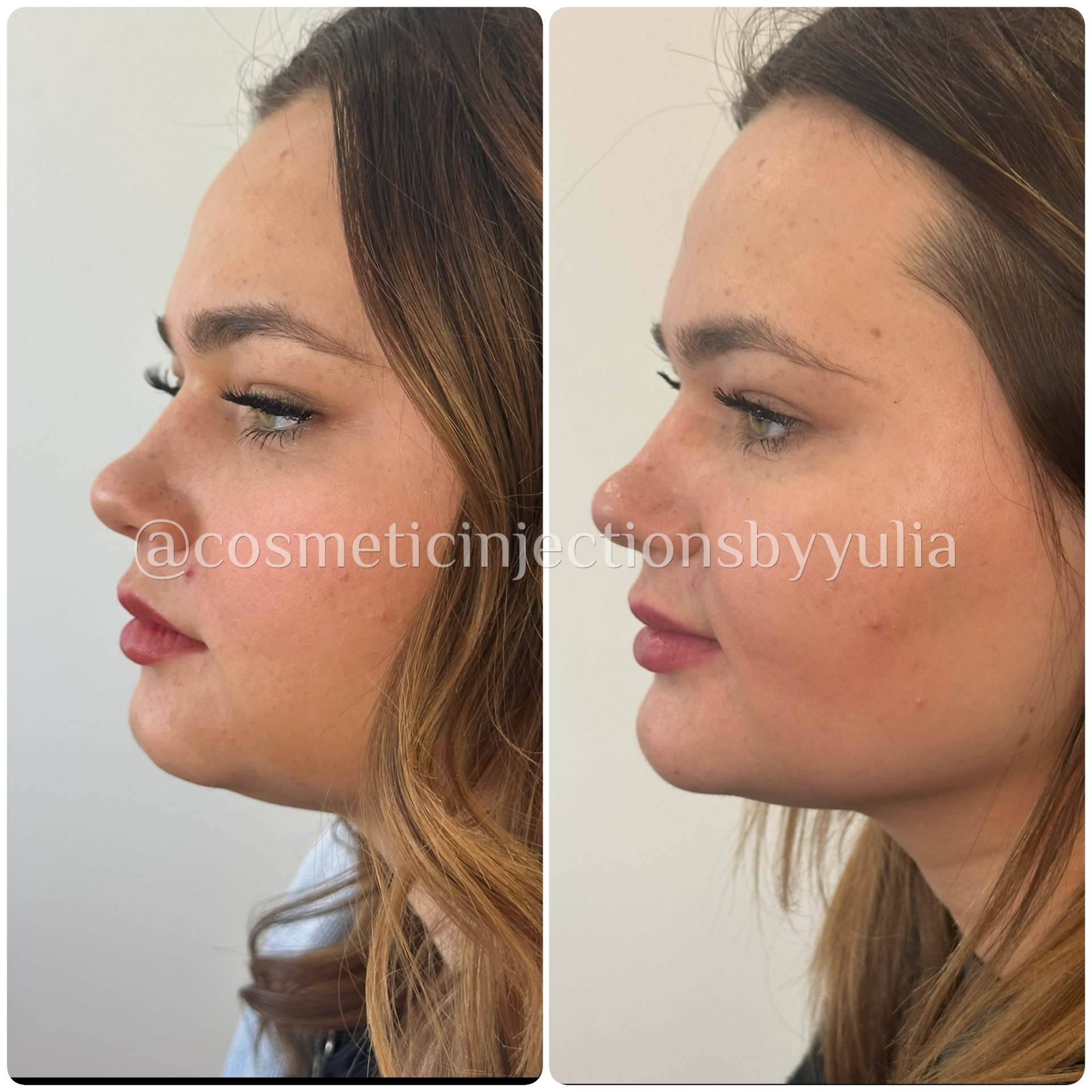 Chin filler to elongate the face and balance proportions