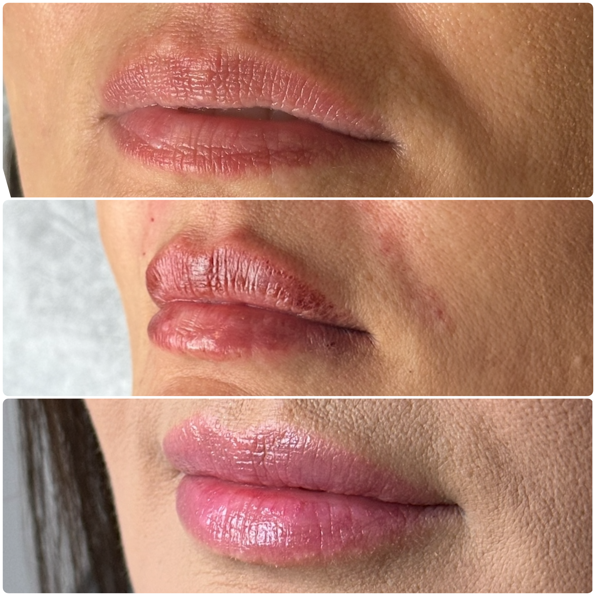 Before, immediatley after, and one week after treatment.