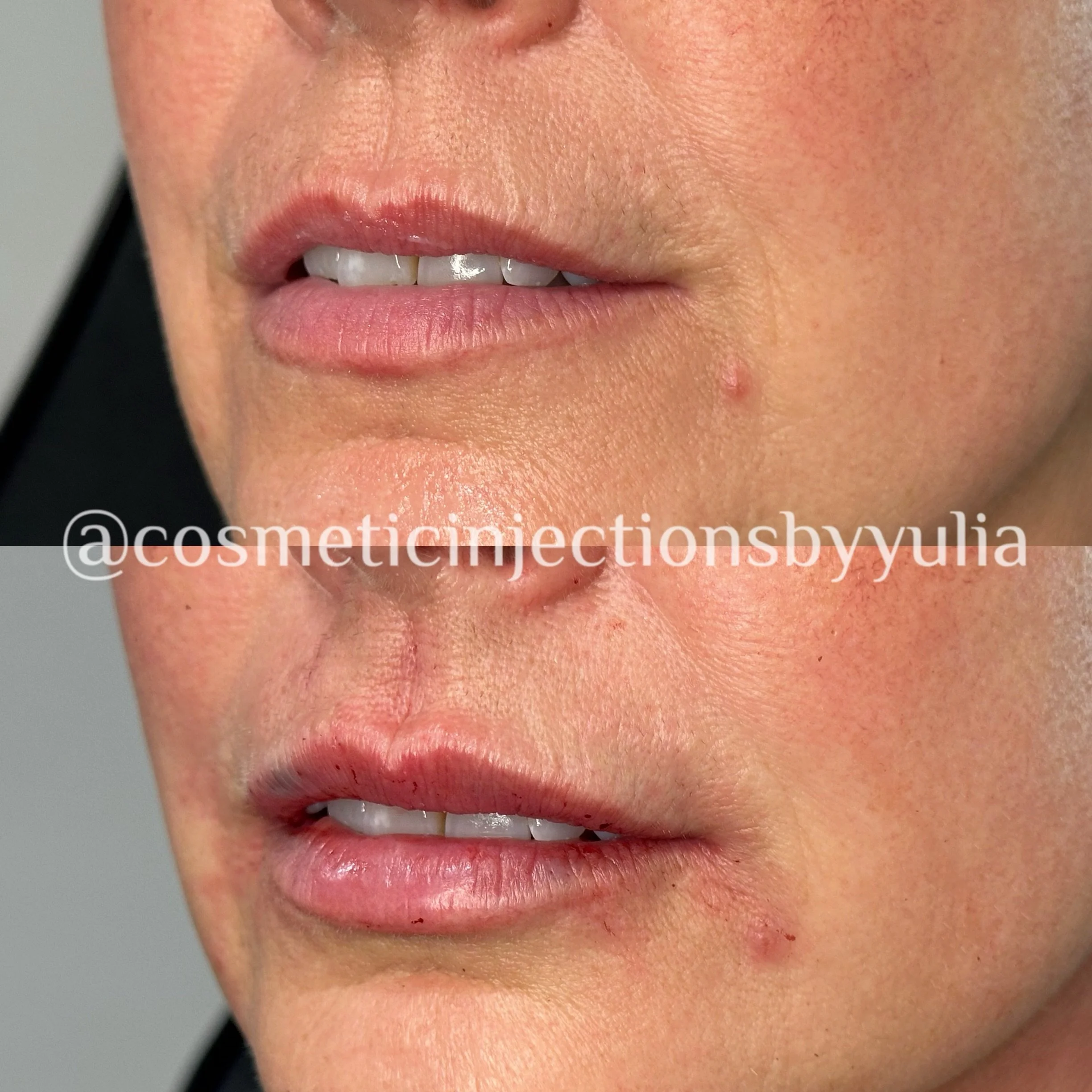 Filler to lips and lip lines.