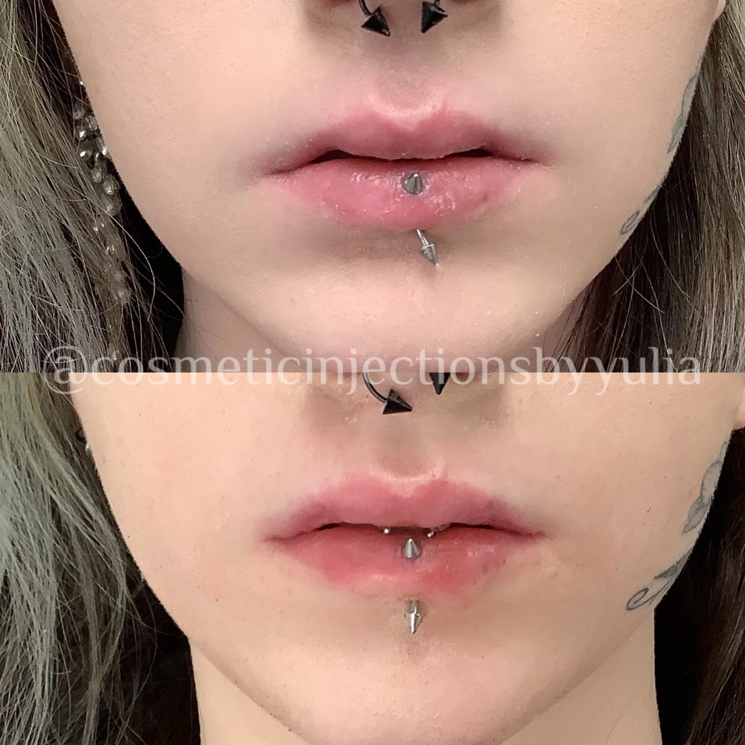 Filler to correct lip shape.