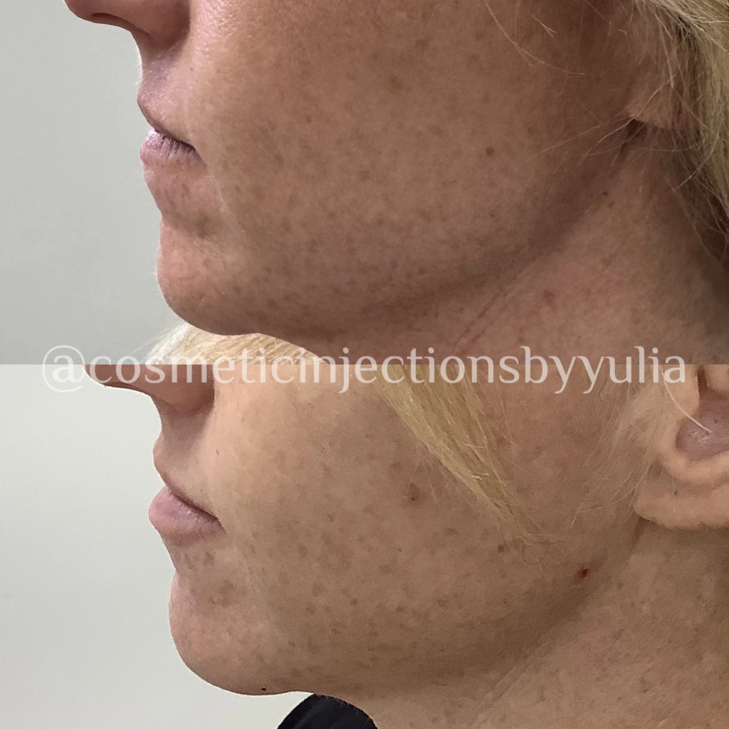 Chin and lip filler results
