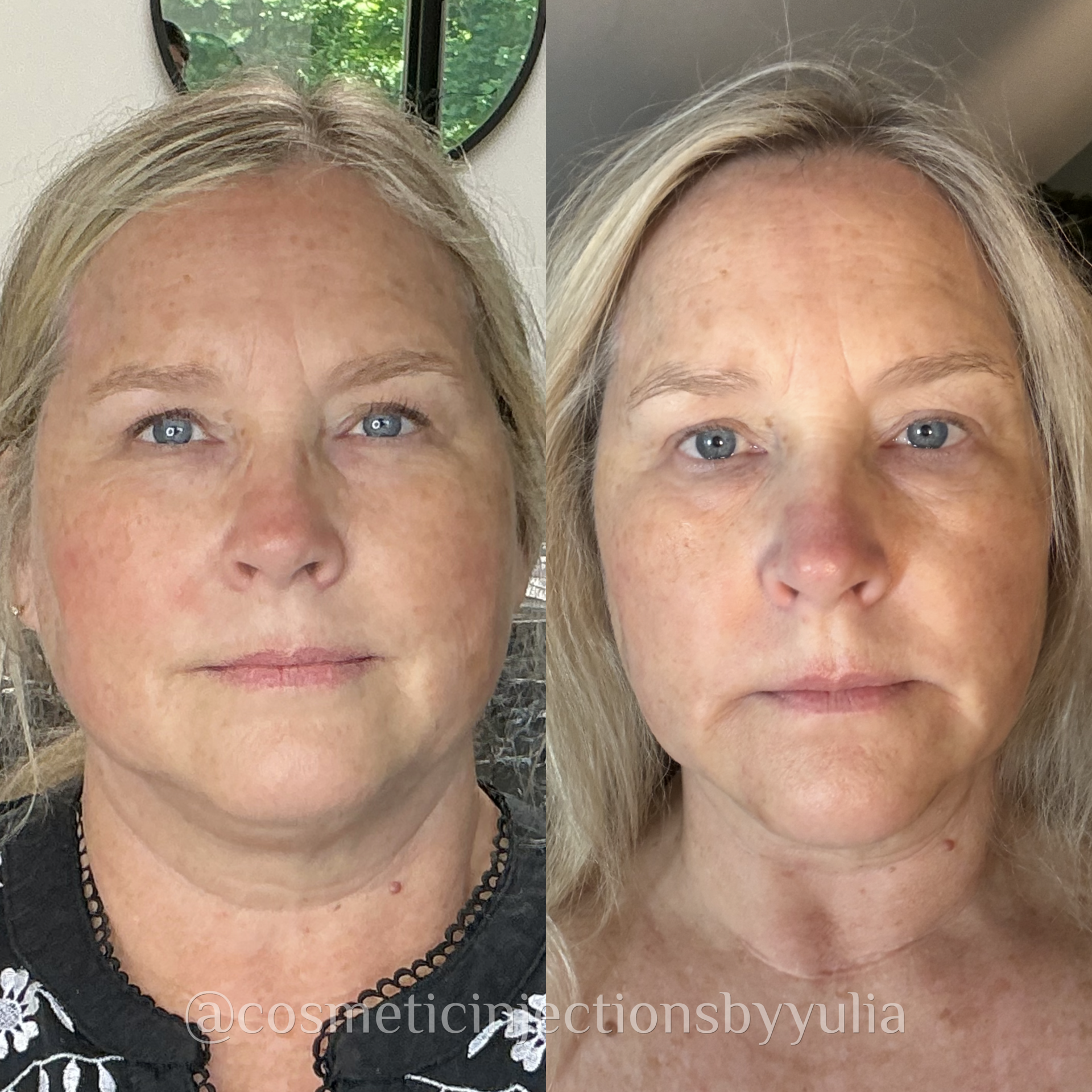 Filler to her chin and jawline for marionette line softening and balancing out facial proportions