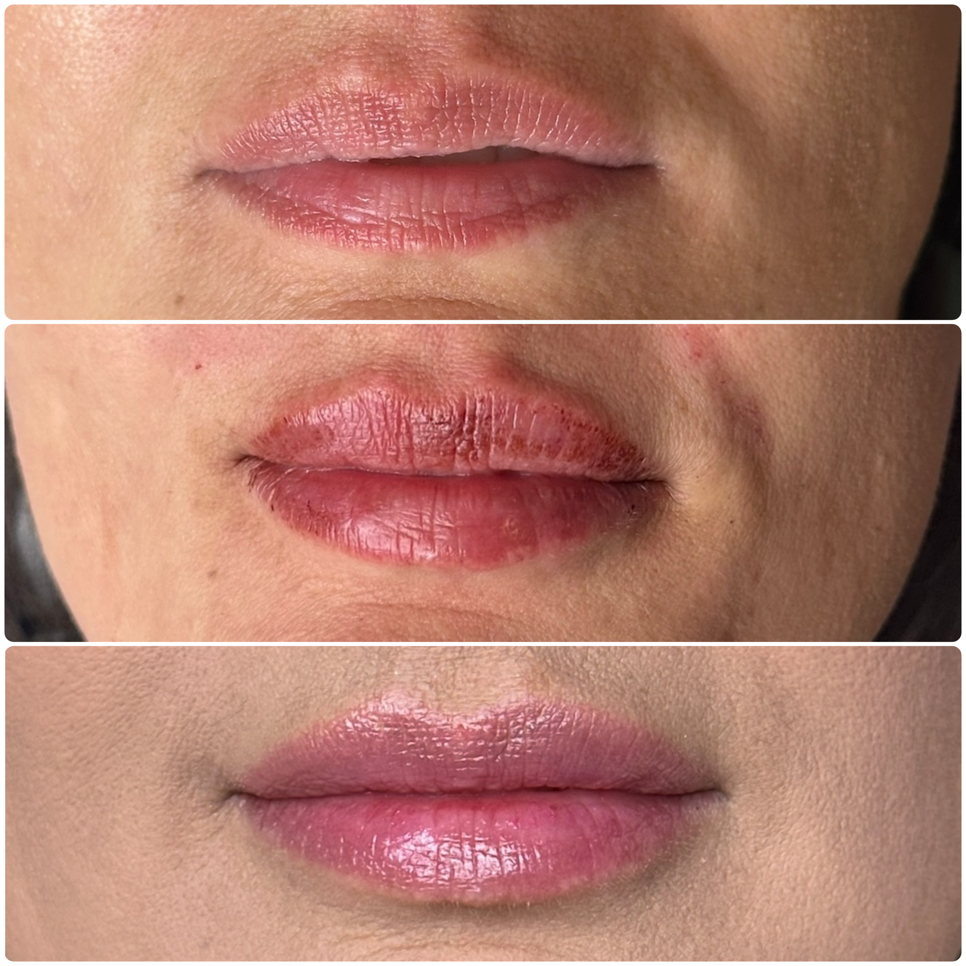 Before, immediatley after, and 1 week after treatment