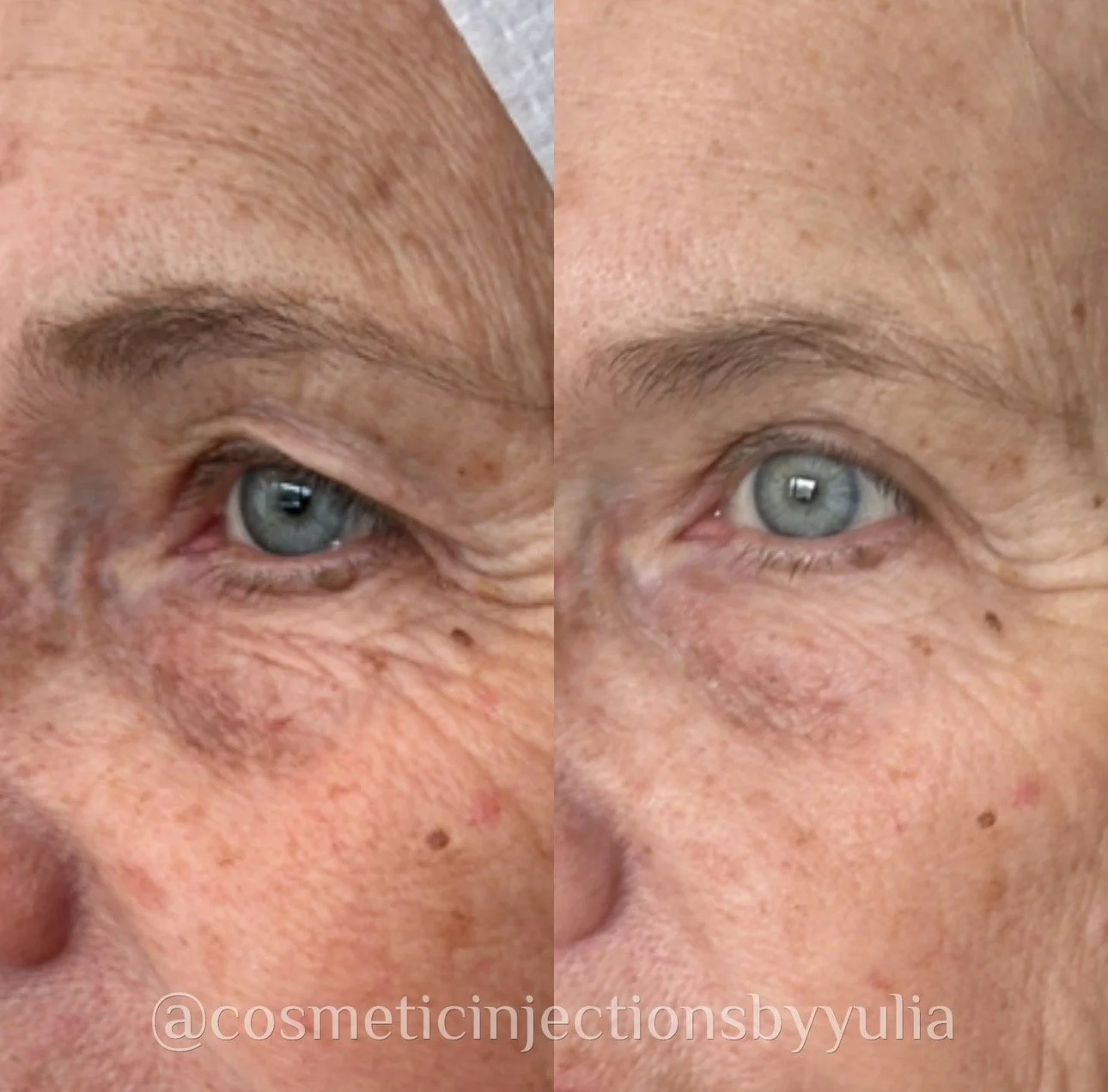After a series of 4 PRX treatments