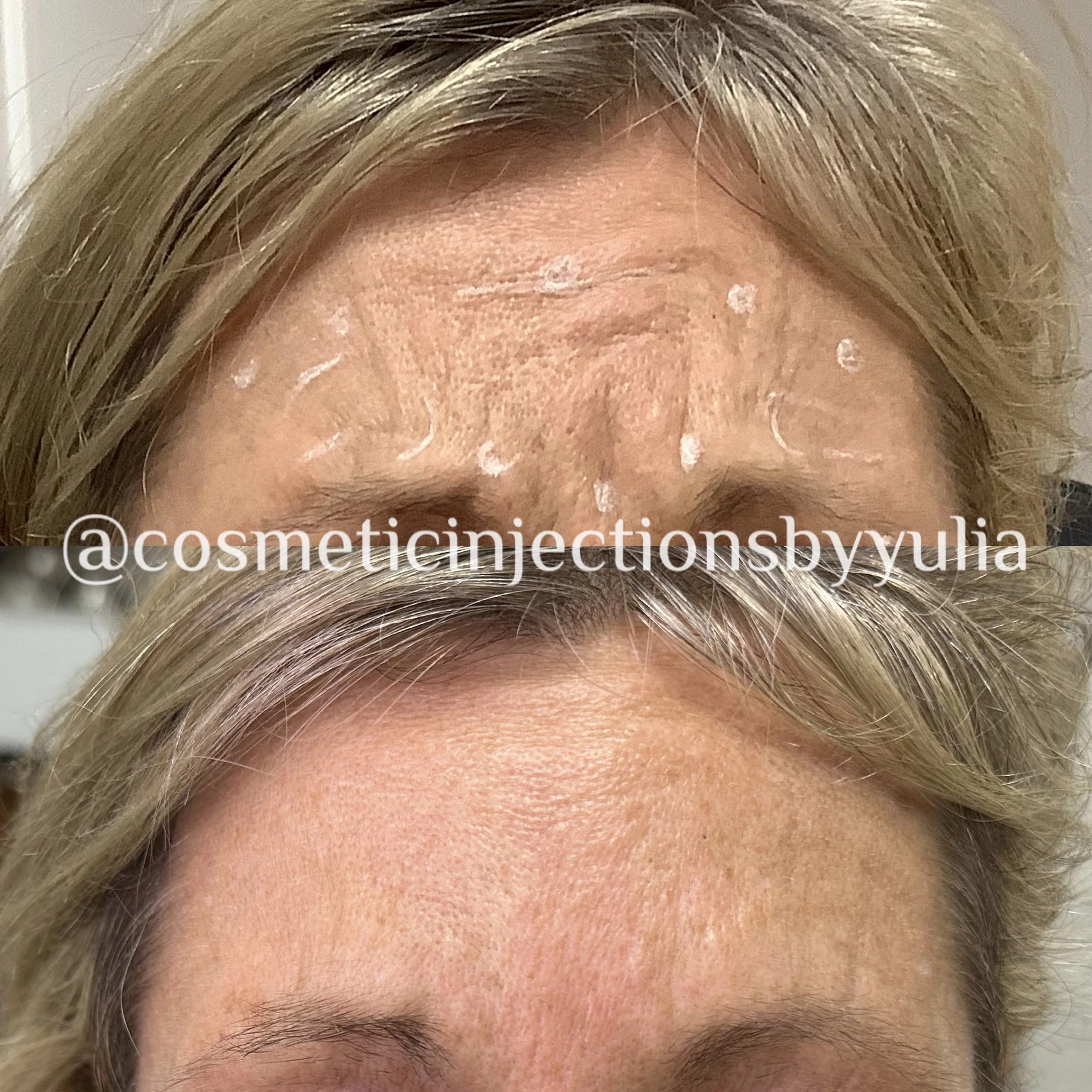 Botox treatment of elevens (frown lines)