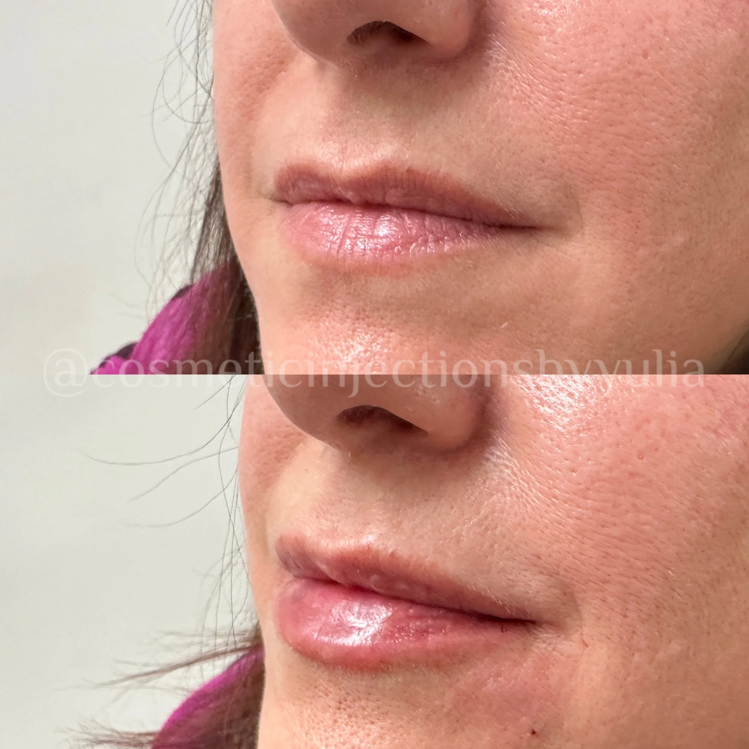 Filler for lip hydration.