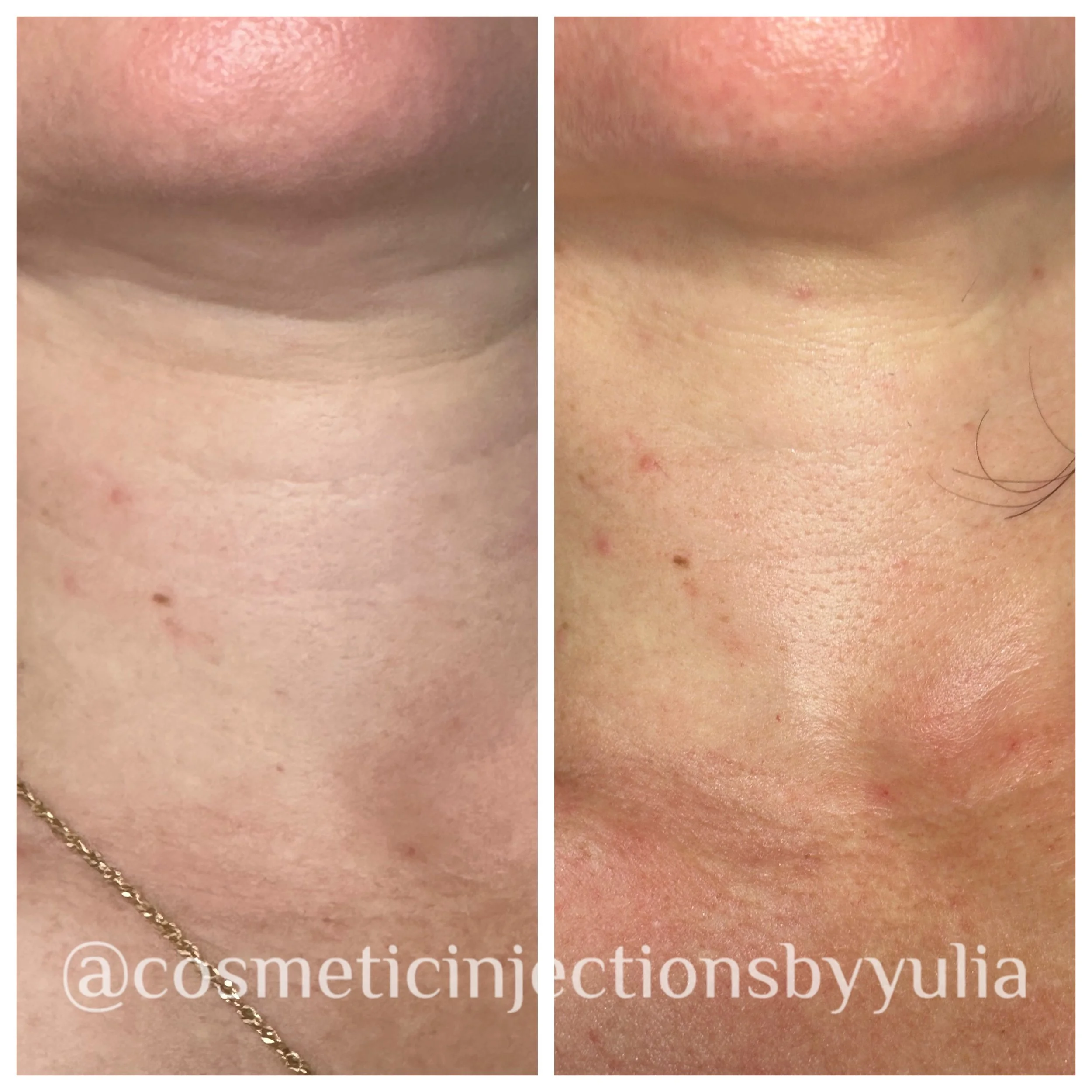 Immediatley after 1 PRX Treatment