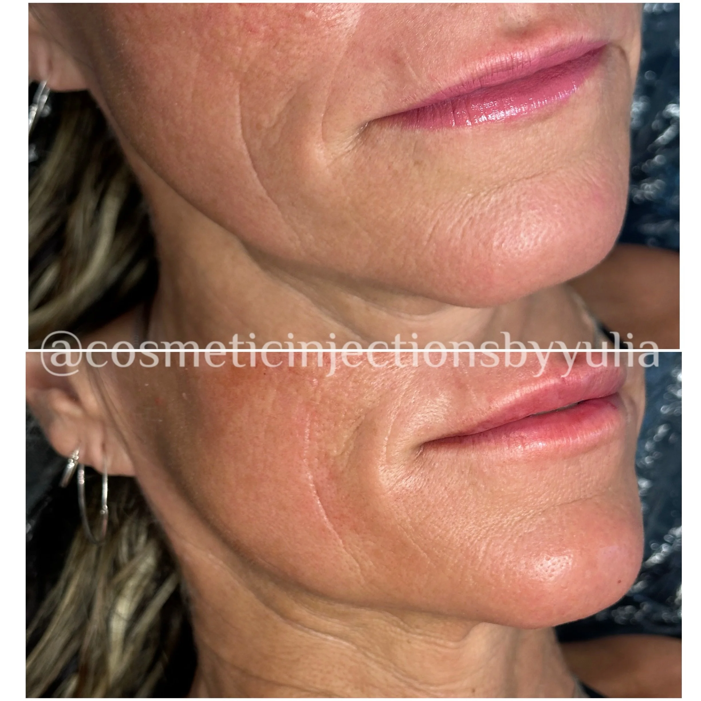 Chin filler results.