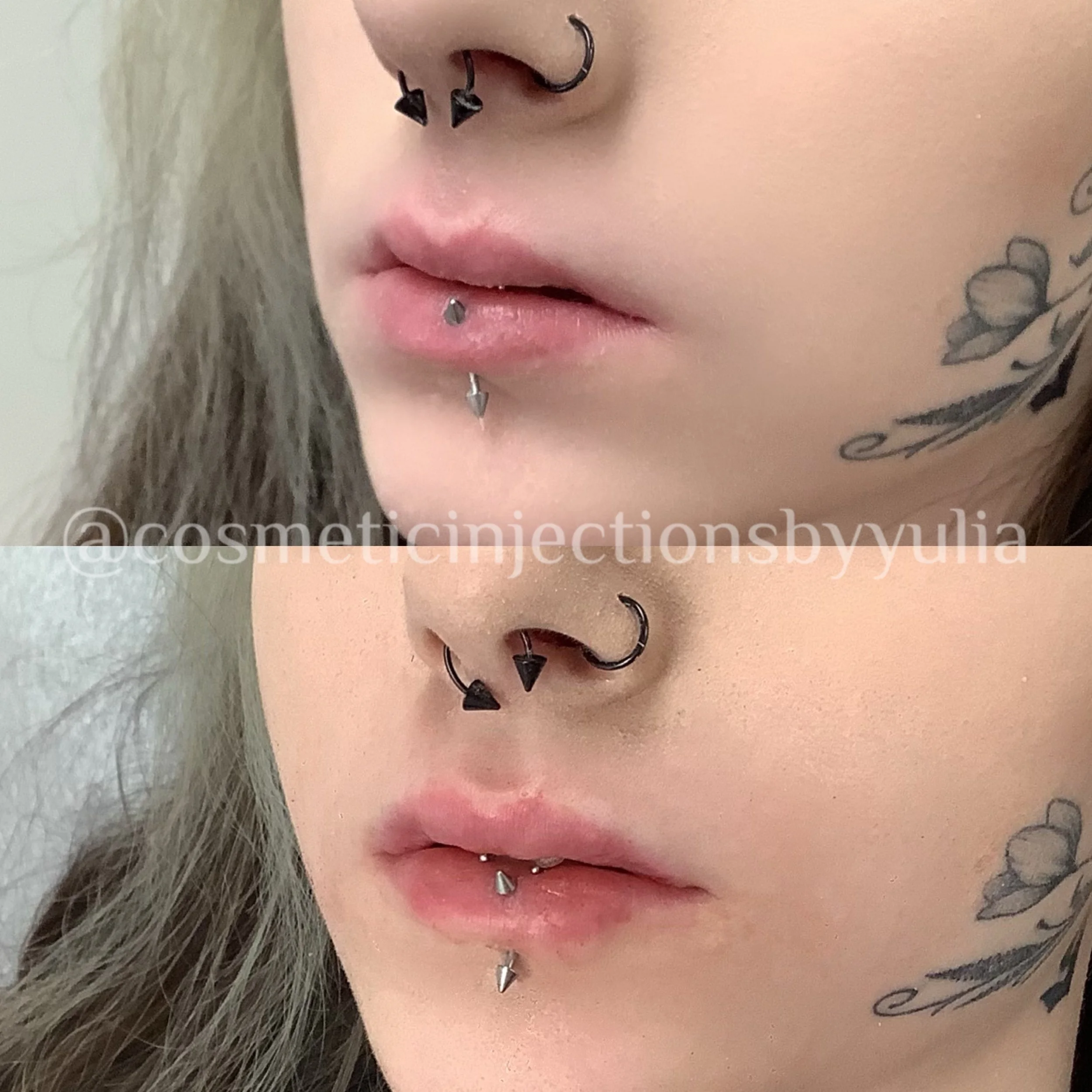 Filler to correct lip shape.