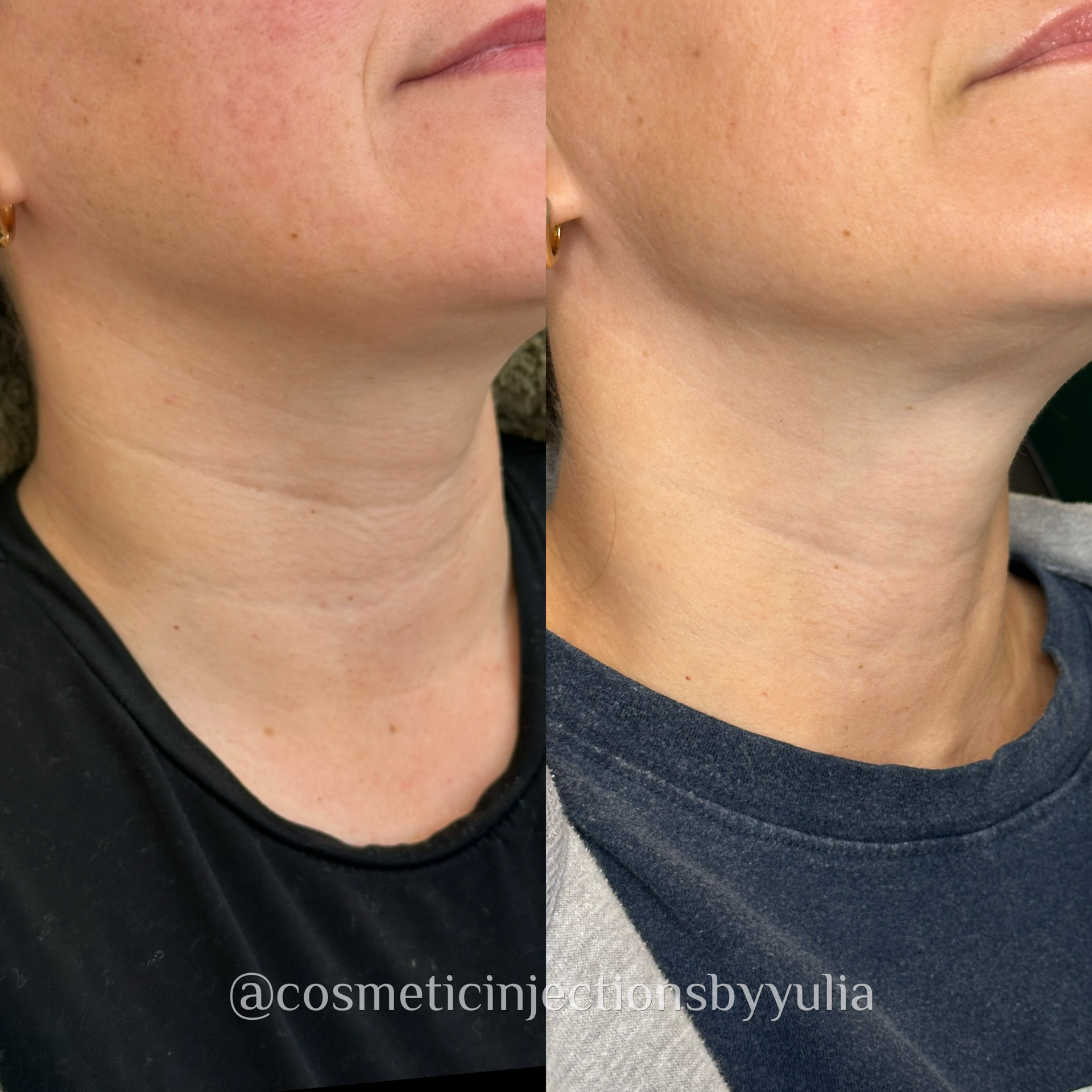 After 2 SkinPen Treatments