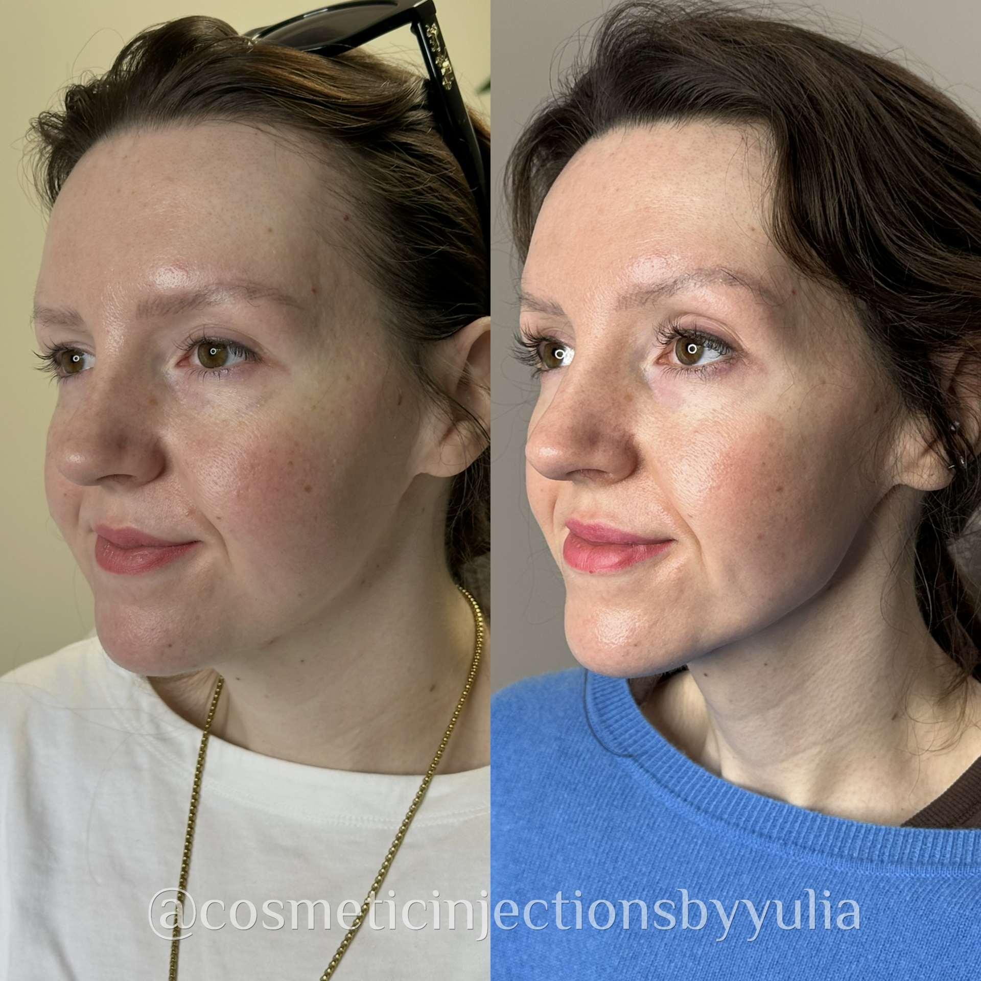 A combination of treatments were used. These photos are 1 year apart. Client had consistent Botox  treatments, 3 treatments of Sculptra, lip filler, and facial balancing fillers to her cheeks, pre-auricular area, and jawline. 